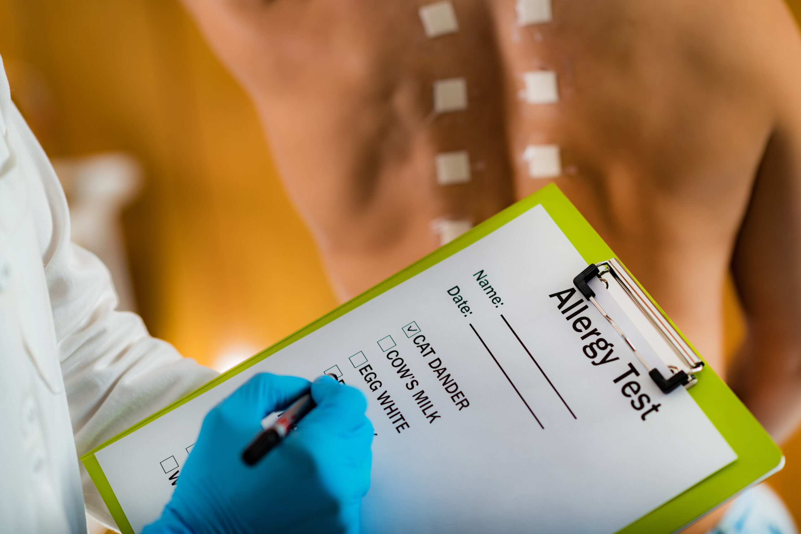 Doctor Doing Skin Allergy Test